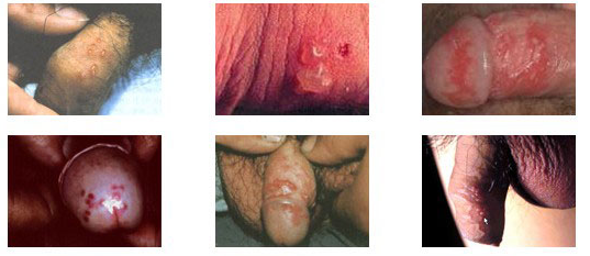 感染生殖器疱疹的原因会有哪些呢